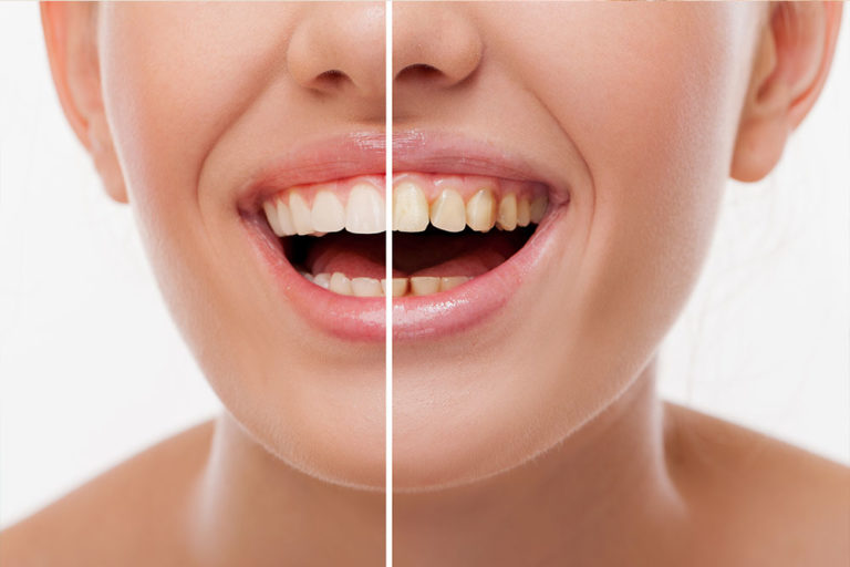 Konya Diş Çürüğü Kırığı Tedavisi Restoratif Diş Tedavisi