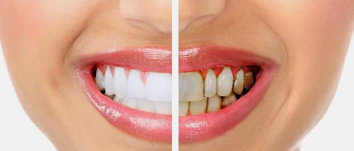 Konya Diş Eti Tedavisi Hastalıkları Uzmanı - Periodontoloji