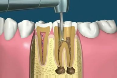 Konya Kanal Tedavisi - Konya Endodonti Doktaları