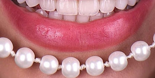 Diş Kaplama Çeşitleri – Diş Kaplama Nasıl Yapılır?