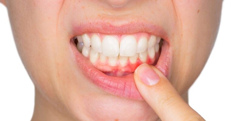 Diş Eti İltihabının Belirtileri Nelerdir? Dentova Estetik Konya